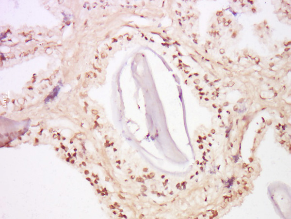 Formalin-fixed and paraffin embedded human prostate tissue labeled with Anti-FOXA2\/HNF 3beta Polyclonal Antibody, Unconjugated (bs-2358R) at 1:300 followed by conjugation to the secondary antibody and DAB staining.