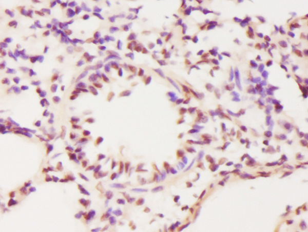 Formalin-fixed and paraffin embedded human lung labeled with Anti-ECT2 Polyclonal Antibody, Unconjugated (bs-4102R) at 1:300 followed by conjugation to the secondary antibody and DAB staining.