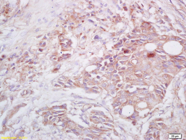 Formalin-fixed and paraffin embedded human lung carcinoma labeled with  Rabbit Anti Cryopyrin\/CIAS1\/NALP3  Polyclonal Antibody, Unconjugated (bs-10021R) at 1:200 followed by conjugation to the secondary antibody and DAB staining