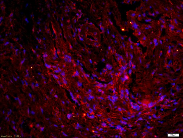 paraformaldehyde-fixed, paraffin embedded human neurofibroma tissue; Antigen retrieval by boiling in sodium citrate buffer(pH6) for 15min; Block endogenous peroxidase by 3% hydrogen peroxide for 30 minutes; Blocking buffer (normal goat serum) at 37°C for 20min; Antibody incubation with Rabbit Anti-QRFP Polyclonal Antibody, Unconjugated (bs-11534R) at 1:200 overnight at 4°C, followed by a conjugated secondary and DAB staining