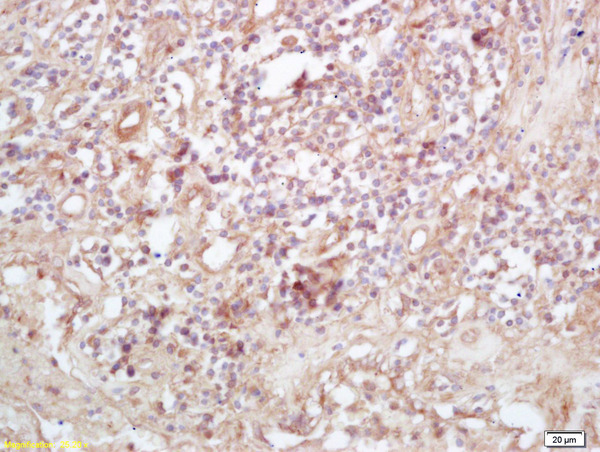 Formalin-fixed and paraffin embedded human lung carcinoma labeled with Rabbit Anti Exportin 1/CRM1 Polyclonal Antibody, Unconjugated (bs-10151R) at 1:200 followed by conjugation to the secondary antibody and DAB staining