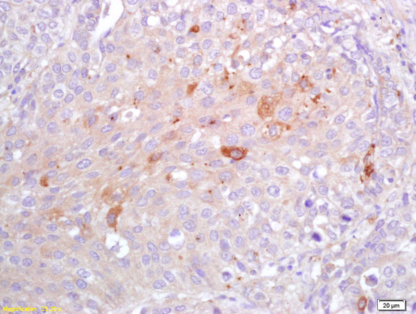 Formalin-fixed and paraffin embedded human lung carcinoma labeled with Rabbit Anti CRP Polyclonal Antibody, Unconjugated (bs-0155R) at 1:200 followed by conjugation to the secondary antibody and DAB staining