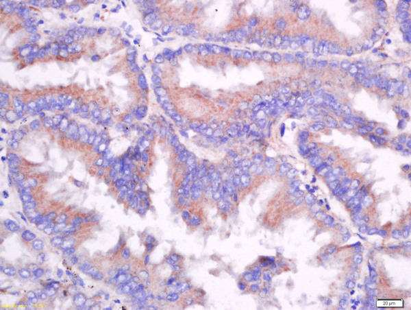 Formalin-fixed and paraffin embedded human lung carcinoma labeled with Anti-CD55/DAF Polyclonal Antibody, Unconjugated (bs-1552R) at 1:200 followed by conjugation to the secondary antibody and DAB staining.