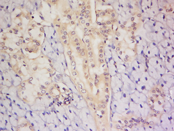 Formalin-fixed and paraffin embedded human thyroid labeled with Anti-C8orf72 Polyclonal Antibody, Unconjugated (bs-15299R) at 1:200 followed by conjugation to the secondary antibody and DAB staining.