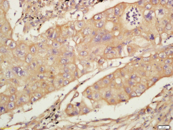 Formalin-fixed and paraffin embedded human lung carcinoma labeled with Anti-CD44 Polyclonal Antibody, Unconjugated (bs-2507R) at 1:200 followed by conjugation to the secondary antibody and DAB staining