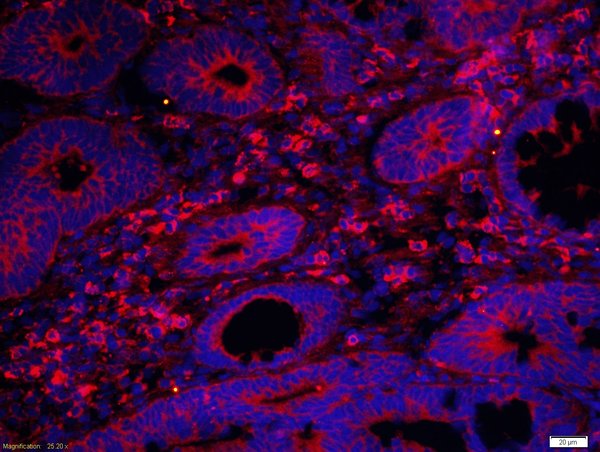 Human colon cancer 4% Paraformaldehyde-fixed and paraffin-embedded.\nAntigen retrieval: Citrate buffer ( 0.01M, pH 6.0 ) boiling bath for 15min; Blocking buffer (normal goat serum 10%) at 37℃ for 20 min;\nIncubation: Anti-DNase II Polyclonal Antibody, Unconjugated(bs-7652R) 1:200, overnight at 4°C; The secondary antibody was Goat Anti-Rabbit IgG, Cy3 conjugated(bs-0295G-Cy3)used at 1:200 dilution for 40 minutes at 37°C. DAPI(5ug/ml,blue) was used to stain the cell nuclei\n