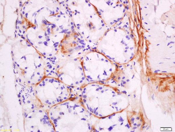 Formalin-fixed and paraffin embedded human laryngocarcinoma labeled with Anti-DNase II Polyclonal Antibody, Unconjugated (bs-7652R) at 1:200 followed by conjugation to the secondary antibody and DAB staining.