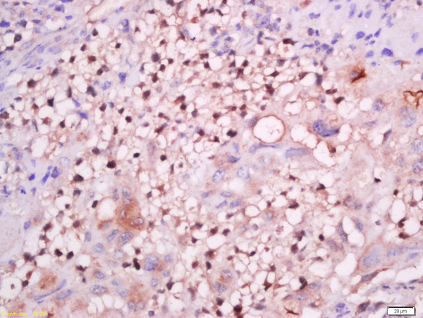 Formalin-fixed and paraffin embedded mouse placenta labeled with Anti-GCMA Polyclonal Antibody, Unconjugated (bs-6306R) at 1:200 followed by conjugation to the secondary antibody and DAB staining. Formalin-fixed and paraffin embedded mouse placenta labeled with Anti-GCMA Polyclonal Antibody, Unconjugated (bs-6306R) at 1:200 followed by conjugation to the secondary antibody and DAB staining.