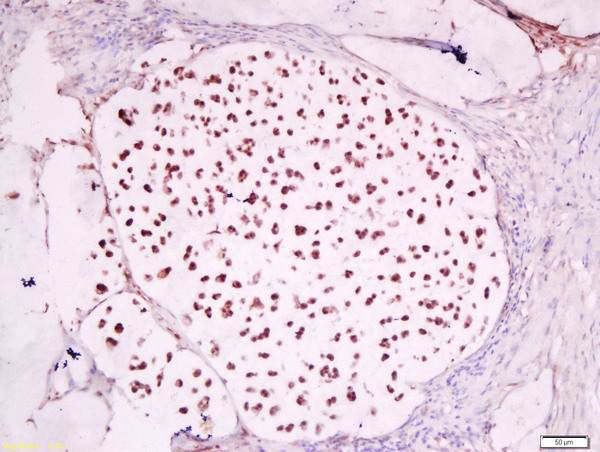 Formalin-fixed and paraffin embedded human cervical carcinoma labeled with Anti-GCMA Polyclonal Antibody, Unconjugated (bs-6306R) at 1:200 followed by conjugation to the secondary antibody and DAB staining.