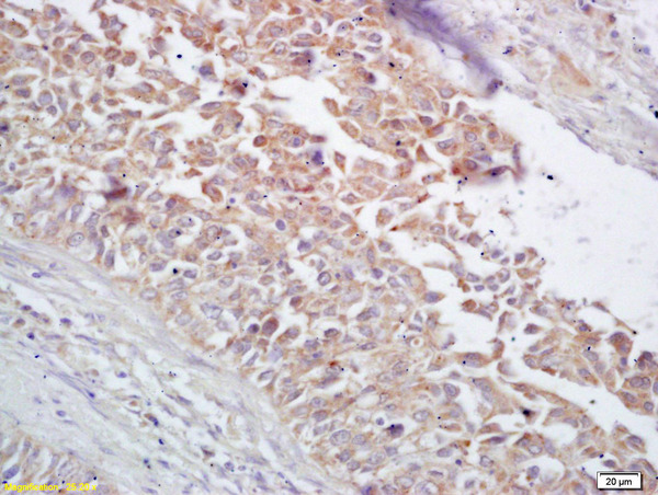 Formalin-fixed and paraffin embedded human lung carcinoma labeled with Rabbit Anti CYP5A1/Thromboxane synthase Polyclonal Antibody, Unconjugated (bs-4019R) at 1:200 followed by conjugation to the secondary antibody and DAB staining