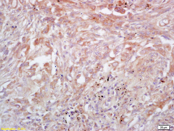 Formalin-fixed and paraffin embedded human lung carcinoma labeled with Rabbit Anti Trk A/B/C Polyclonal Antibody, Unconjugated (bs-0192R) at 1:200 followed by conjugation to the secondary antibody and DAB staining