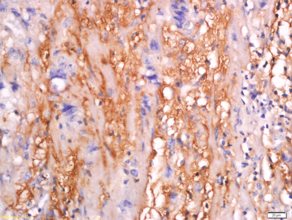 Formalin-fixed and paraffin embedded human colon carcinoma tissue labeled with Anti-sFRP-4 Polyclonal Antibody, Unconjugated (bs-1331R) at 1:200 followed by conjugation to the secondary antibody and DAB staining.