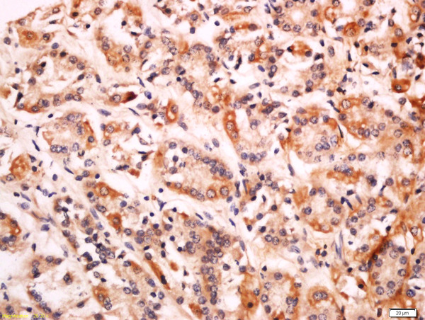 Formalin-fixed and paraffin embedded human gastric carcinoma labeled with Anti-CD99L2 Polyclonal Antibody, Unconjugated (bs-13742R) at 1:200 followed by conjugation to the secondary antibody and DAB staining.