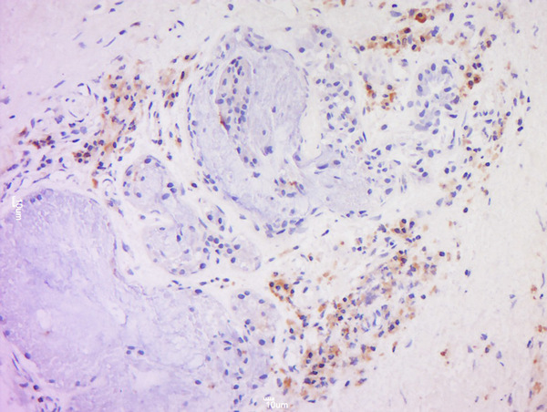 Formalin-fixed and paraffin embedded human larynocarcinoma labeled with  Anti-CD20 Polyclonal Antibody, Unconjugated (bs-0080R) at 1:200 followed by conjugation to the secondary antibody and DAB staining.