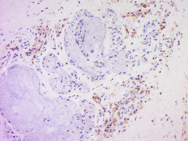 Formalin-fixed and paraffin embedded human larynocarcinoma labeled with Anti-CD20 Polyclonal Antibody, Unconjugated (bs-0080R) at 1:200 followed by conjugation to the secondary antibody and DAB staining.