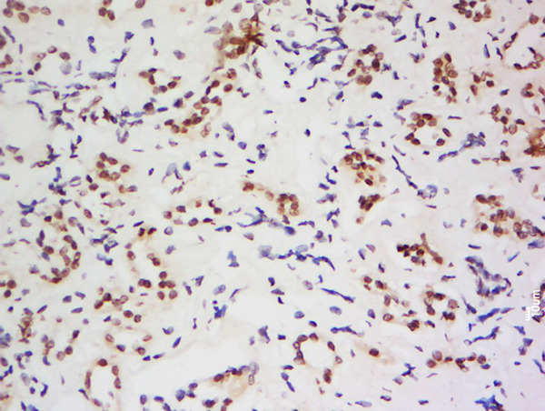 Formalin-fixed and paraffin embedded human kidney labeled with Anti-AARE Polyclonal Antibody, Unconjugated (bs-5983R) at 1:200 followed by conjugation to the secondary antibody and DAB staining.