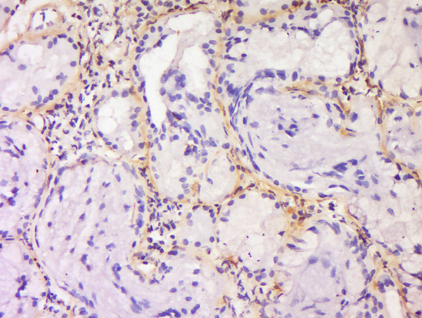 Formalin-fixed and paraffin embedded human laryngocarcinoma labeled with Anti-SPRR3/Cornifin B Polyclonal Antibody, Unconjugated (bs-11163R) at 1:200 followed by conjugation to the secondary antibody and DAB staining.