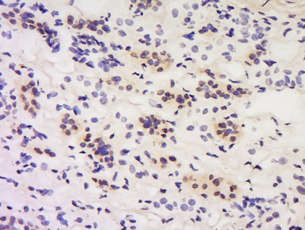 Formalin-fixed and paraffin embedded human kidney labeled with Anti-Calcipressin 1/DSCR 1 Polyclonal Antibody, Unconjugated (bs-11541R) at 1:200 followed by conjugation to the secondary antibody and DAB staining.