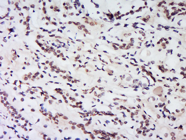 Formalin-fixed and paraffin embedded human kidney labeled with Rabbit Anti-HS1BP3 Polyclonal Antibody, Unconjugated (bs-11568R) at 1:200 followed by conjugation to the secondary antibody and DAB staining.