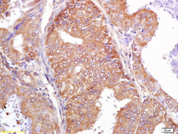 Formalin-fixed and paraffin embedded human breast carcinoma labeled with Rabbit Anti PALB2 Polyclonal Antibody, Unconjugated (bs-0588R) at 1:200 followed by conjugation to the secondary antibody and DAB staining