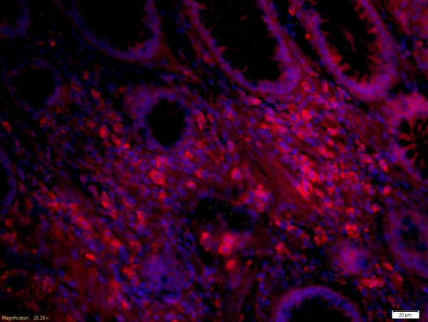 paraformaldehyde-fixed, paraffin embedded human colon carcinoma tissue; Antigen retrieval by boiling in sodium citrate buffer(pH6) for 15min; Block endogenous peroxidase by 3% hydrogen peroxide for 30 minutes; Blocking buffer (normal goat serum) at 37°C for 20min; Antibody incubation with Rabbit Anti-IL12 Polyclonal Antibody, Unconjugated (bs-1789R) at 1:500 overnight at 4°C, followed by a conjugated secondary and DAPI staining