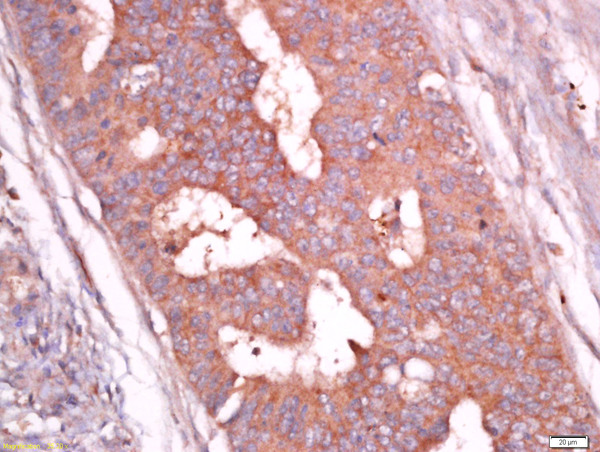 paraformaldehyde-fixed, paraffin embedded human colon carcinoma tissue; Antigen retrieval by boiling in sodium citrate buffer(pH6) for 15min; Block endogenous peroxidase by 3% hydrogen peroxide for 30 minutes; Blocking buffer (normal goat serum) at 37°C for 20min; Antibody incubation with Rabbit Anti-Troponin T Polyclonal Antibody, Unconjugated (bs-10648R) at 1:400 overnight at 4°C, followed by a conjugated secondary and DAB staining