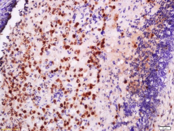 Formalin-fixed and paraffin embedded human skin labeled with Anti-EXOSC10/PMSCL2 Polyclonal Antibody, Unconjugated (bs-13120R) at 1:200 followed by conjugation to the secondary antibody and DAB staining.\n