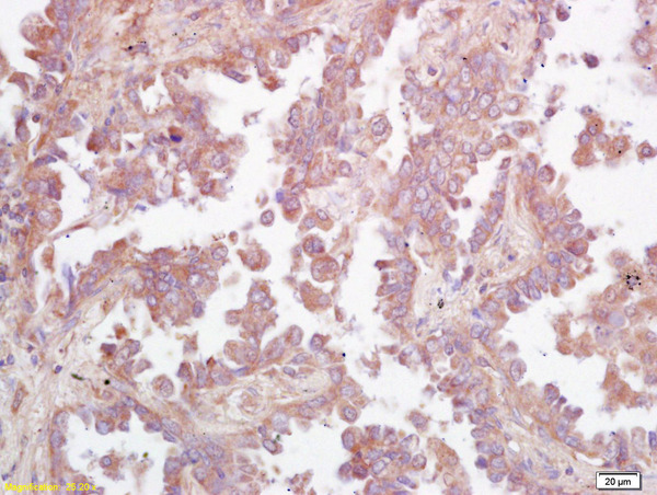 Formalin-fixed and paraffin embedded human lung carcinoma labeled with Rabbit Anti GCS/glucosylceramide synthase Polyclonal Antibody, Unconjugated (bs-0701R) at 1:200 followed by conjugation to the secondary antibody and DAB staining