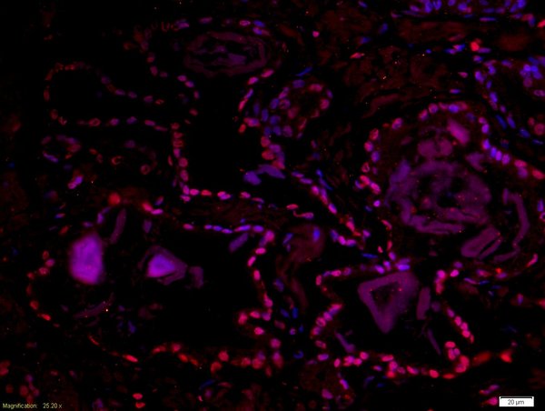 Paraformaldehyde-fixed, paraffin embedded human prostate tissue; Antigen retrieval by boiling in sodium citrate buffer(pH6) for 15min; Block endogenous peroxidase by 3% hydrogen peroxide for 30 minutes; Blocking buffer (normal goat serum) at 37°C for 20min; Antibody incubation with Rabbit Anti-DMA/Dmrt1a Polyclonal Antibody, Unconjugated (bs-11276R) at 1:500 overnight at 4°C, followed by a conjugated secondary and DAB staining
