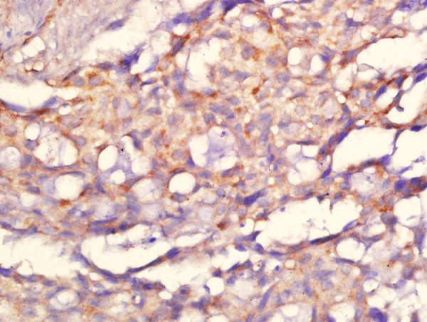 Paraformaldehyde-fixed, paraffin embedded human lung carcinoma tissue; Antigen retrieval by boiling in sodium citrate buffer(pH6) for 15min; Block endogenous peroxidase by 3% hydrogen peroxide for 30 minutes; Blocking buffer (normal goat serum) at 37°C for 20min; Antibody incubation with Rabbit Anti-C10orf93 Polyclonal Antibody, Unconjugated (bs-9772R) at 1:200 overnight at 4°C, followed by a conjugated secondary and DAB staining