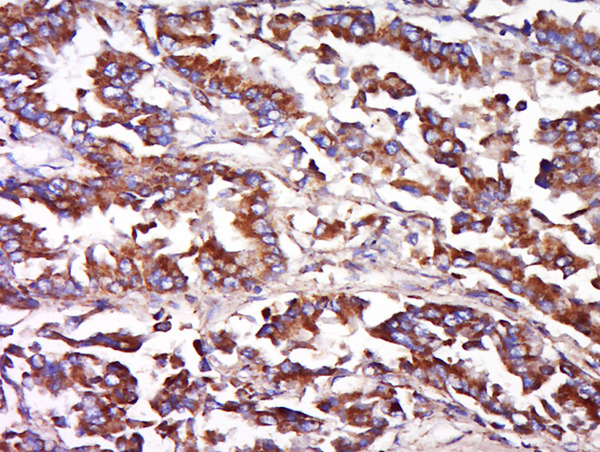 Formalin-fixed and paraffin embedded human lung carcinoma labeled with Anti-FAIM3 Polyclonal Antibody, Unconjugated (bs-20130R) at 1:500 followed by conjugation to the secondary antibody and DAB staining.