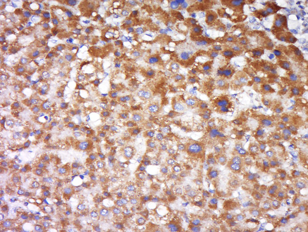 Formalin-fixed and paraffin embedded human liver carcinoma labeled with Anti-FAIM3 Polyclonal Antibody, Unconjugated (bs-20130R) at 1:500 followed by conjugation to the secondary antibody and DAB staining.
