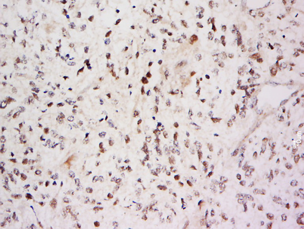 Formalin-fixed and paraffin embedded Glioma cell tumor labeled with Anti-SARA Polyclonal Antibody, Unconjugated (bs-19393R) at 1:500 followed by conjugation to the secondary antibody and DAB staining.