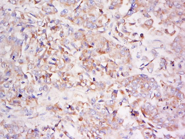 Formalin-fixed and paraffin embedded human lung carcinoma labeled with Anti-LDLRAD3 Polyclonal Antibody, Unconjugated (bs-18209R) at 1:500 followed by conjugation to the secondary antibody and DAB staining