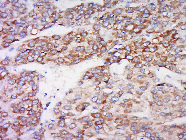 Formalin-fixed and paraffin embedded rat brain labeled with Anti-IDO2 Polyclonal Antibody, Unconjugated (bs-16640R) at 1:500 followed by conjugation to the secondary antibody and DAB staining. Formalin-fixed and paraffin embedded rat brain labeled with Anti-IDO2 Polyclonal Antibody, Unconjugated (bs-16640R) at 1:500 followed by conjugation to the secondary antibody and DAB staining.