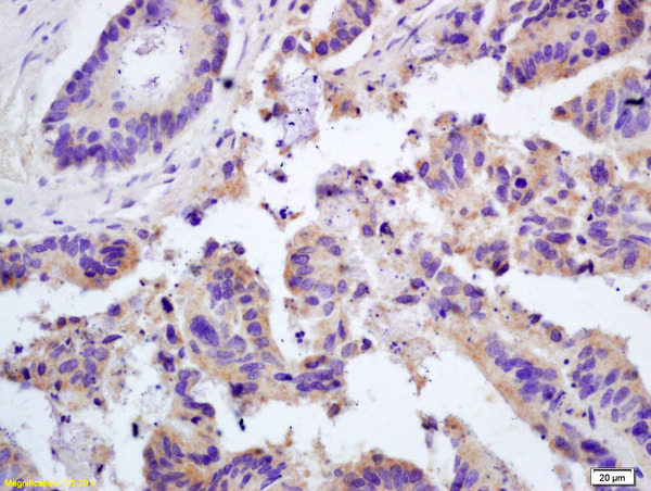 Formalin-fixed and paraffin embedded human colon carcinoma labeled with  Rabbit Anti Galectin 3 Polyclonal Antibody, Unconjugated (bs-0721R) at 1:200 followed by conjugation to the secondary antibody and DAB staining