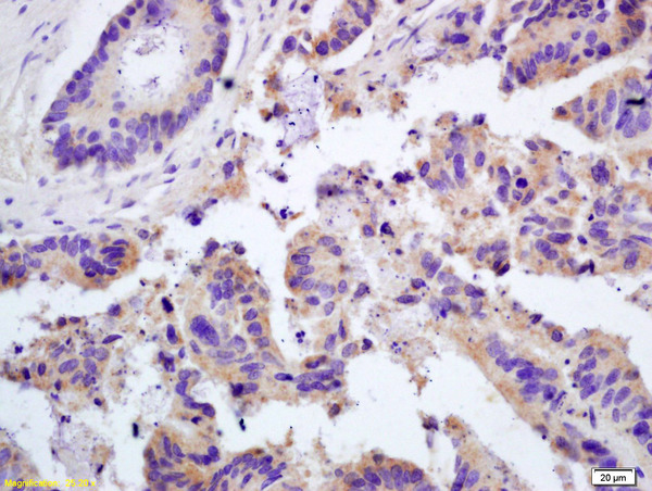 Formalin-fixed and paraffin embedded human colon carcinoma labeled with Rabbit Anti Galectin 3 Polyclonal Antibody, Unconjugated (bs-0721R) at 1:200 followed by conjugation to the secondary antibody and DAB staining