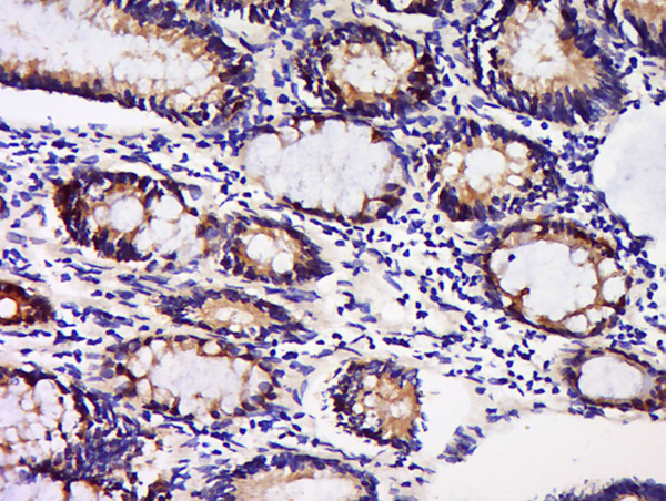 Formalin-fixed and paraffin embedded human colon carcinoma labeled with Anti-GDNFRA Polyclonal Antibody, Unconjugated (bs-0201R) at 1:200 followed by conjugation to the secondary antibody and DAB staining.