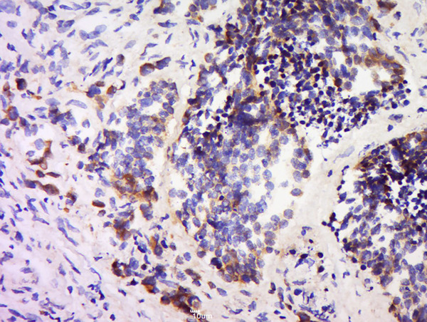 Formalin-fixed and paraffin embedded human colon carcinoma labeled with Anti-SPARC Polyclonal Antibody, Unconjugated (bs-1133R) at 1:200 followed by conjugation to the secondary antibody and DAB staining.