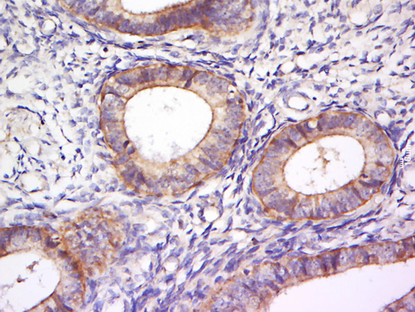 Paraformaldehyde-fixed, paraffin embedded human cervical cancer; Antigen retrieval by boiling in sodium citrate buffer (pH6) for 15min; Block endogenous peroxidase by 3% hydrogen peroxide for 30 minutes; Blocking buffer (normal goat serum) at 37°C for 20min; Antibody incubation with Rabbit Anti-PLEKHA7 Polyclonal Antibody, Unconjugated (bs-13730R) at 1:200 overnight at 4°C, followed by a conjugated secondary for 90 minutes and DAB staining.