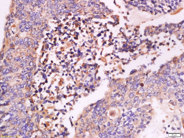Paraformaldehyde-fixed, paraffin embedded human colon carcinoma tissue; Antigen retrieval by boiling in sodium citrate buffer(pH6) for 15min; Block endogenous peroxidase by 3% hydrogen peroxide for 30 minutes; Blocking buffer (normal goat serum) at 37°C for 20min; Antibody incubation with Rabbit Anti-IFN-beta Polyclonal Antibody, Unconjugated (bs-0787R) at 1:500 overnight at 4°C, followed by a conjugated secondary and DAB staining