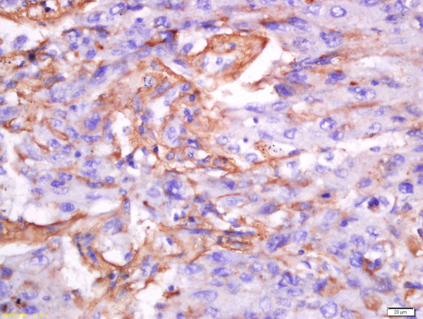 Paraformaldehyde-fixed, paraffin embedded human lung carcinoma tissue; Antigen retrieval by boiling in sodium citrate buffer(pH6) for 15min; Block endogenous peroxidase by 3% hydrogen peroxide for 30 minutes; Blocking buffer (normal goat serum) at 37°C for 20min; Antibody incubation with Rabbit Anti-Exportin-2 Polyclonal Antibody, Unconjugated (bs-1078R) at 1:200 overnight at 4°C, followed by a conjugated secondary and DAB staining