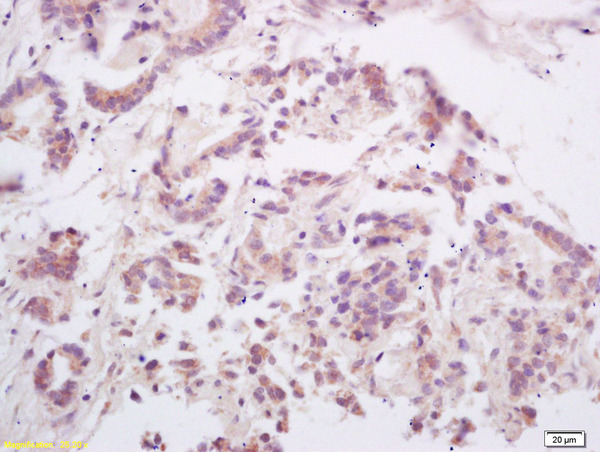 Formalin-fixed and paraffin embedded human gastric carcinoma labeled with  Rabbit Anti OPGL\/RANKL\/ODF Polyclonal Antibody, Unconjugated (bs-0747R) at 1:200 followed by conjugation to the secondary antibody and DAB staining
