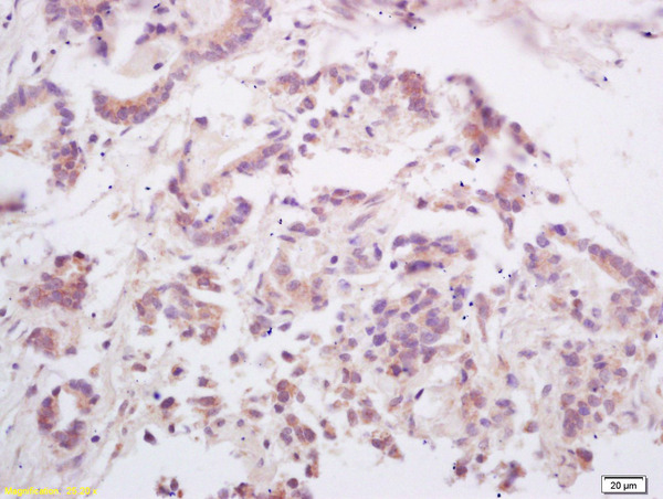 Formalin-fixed and paraffin embedded human gastric carcinoma labeled with Rabbit Anti OPGL/RANKL/ODF Polyclonal Antibody, Unconjugated (bs-0747R) at 1:200 followed by conjugation to the secondary antibody and DAB staining