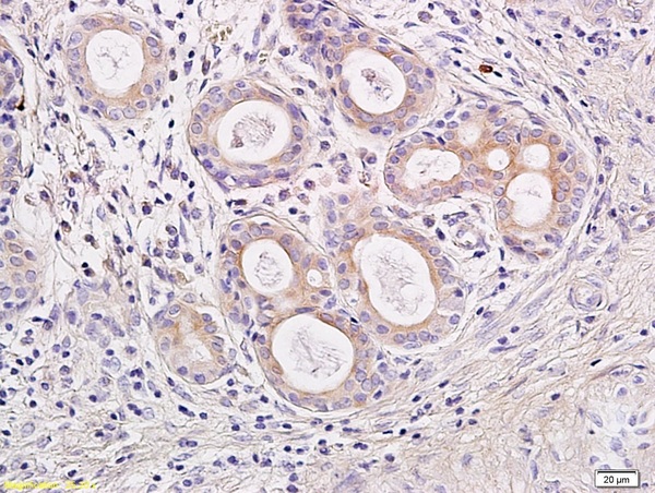Formalin-fixed and paraffin embedded human rhinopolypus labeled with Rabbit Anti IL-23 Polyclonal Antibody, Unconjugated (bs-1193R) at 1:200 followed by conjugation to the secondary antibody and DAB staining