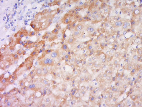 Paraformaldehyde-fixed, paraffin embedded human liver carcinoma; Antigen retrieval by boiling in sodium citrate buffer (pH6) for 15min; Block endogenous peroxidase by 3% hydrogen peroxide for 30 minutes; Blocking buffer (normal goat serum) at 37°C for 20min; Antibody incubation with Rabbit Anti-TSLP Polyclonal Antibody, Unconjugated (bs-0449R) at 1:200 overnight at 4°C, followed by a conjugated secondary for 90 minutes and DAB staining.