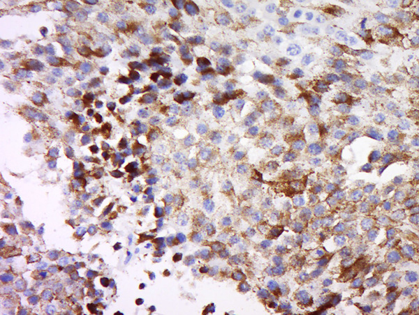 Paraformaldehyde-fixed, paraffin embedded human melanoma; Antigen retrieval by boiling in sodium citrate buffer (pH6) for 15min; Block endogenous peroxidase by 3% hydrogen peroxide for 30 minutes; Blocking buffer (normal goat serum) at 37°C for 20min; Antibody incubation with Rabbit Anti-MAGEB3 Polyclonal Antibody, Unconjugated (bs-6823R) at 1:500 overnight at 4°C, followed by a conjugated secondary for 90 minutes and DAB staining.