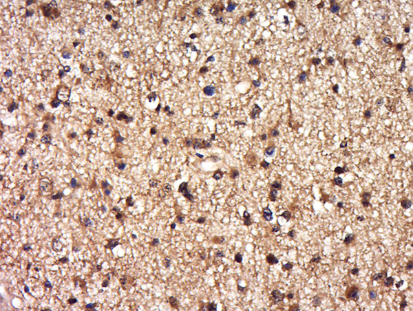 Formalin-fixed and paraffin embedded human brain glioma labeled with Anti-DEPDC1B Polyclonal Antibody, Unconjugated (bs-14278R) at 1:500 followed by conjugation to the secondary antibody and DAB staining.
