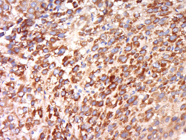 Formalin-fixed and paraffin embedded human liver cancer labeled with Anti-CEP192 Polyclonal Antibody, Unconjugated (bs-13856R) at 1:500 followed by conjugation to the secondary antibody and DAB staining.