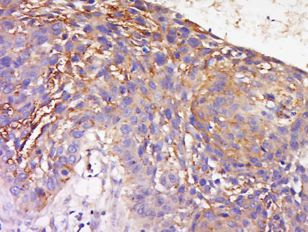 Formalin-fixed and paraffin embedded human lung carcinoma labeled with Anti-TRAM1 Polyclonal Antibody, Unconjugated (bs-16565R) at 1:200 followed by conjugation to the secondary antibody and DAB staining.